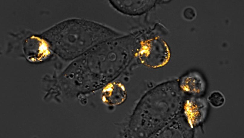 CAR-T cells attacking brightly colored breast cancer cells